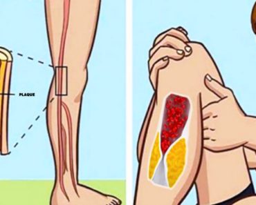 prevent fatal blood clots